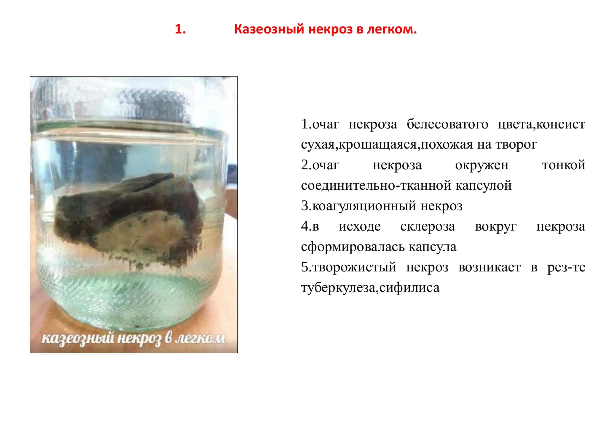 Казеозный некроз