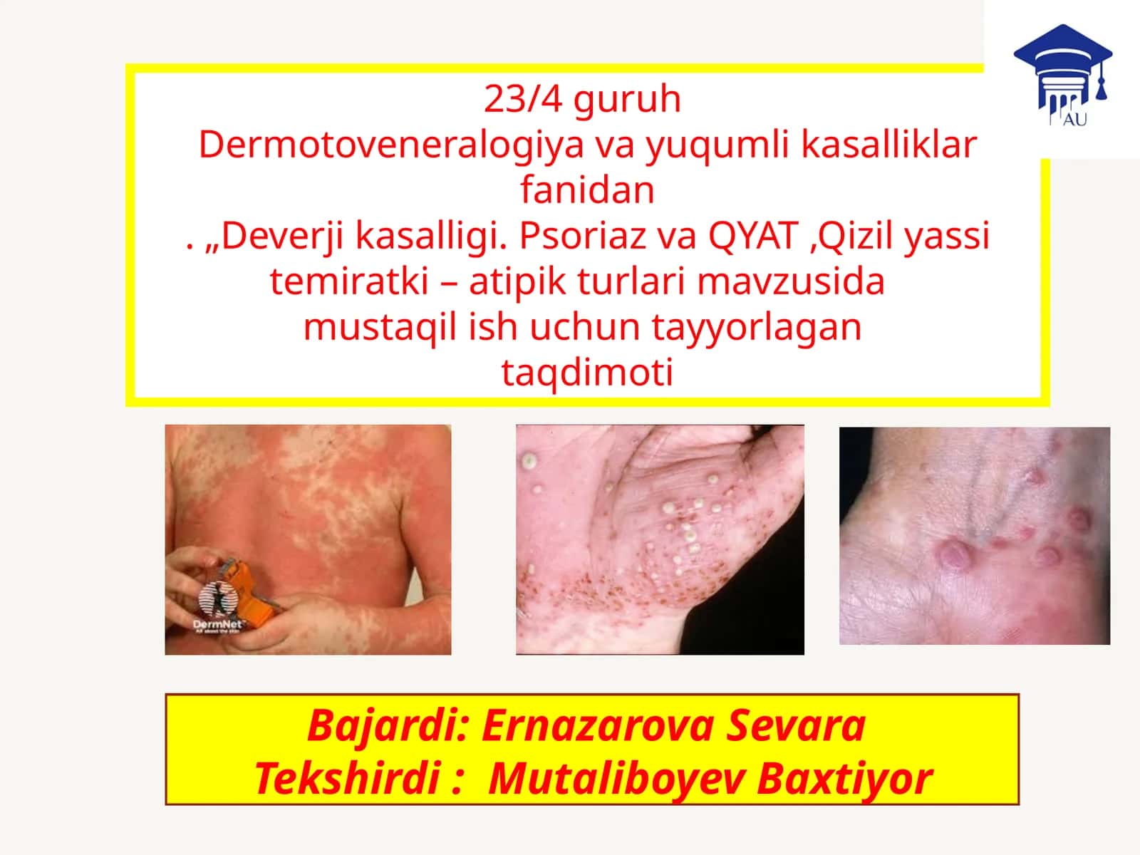 Deverjikasalligi, Psoriaz va Qizilyassi temiratki