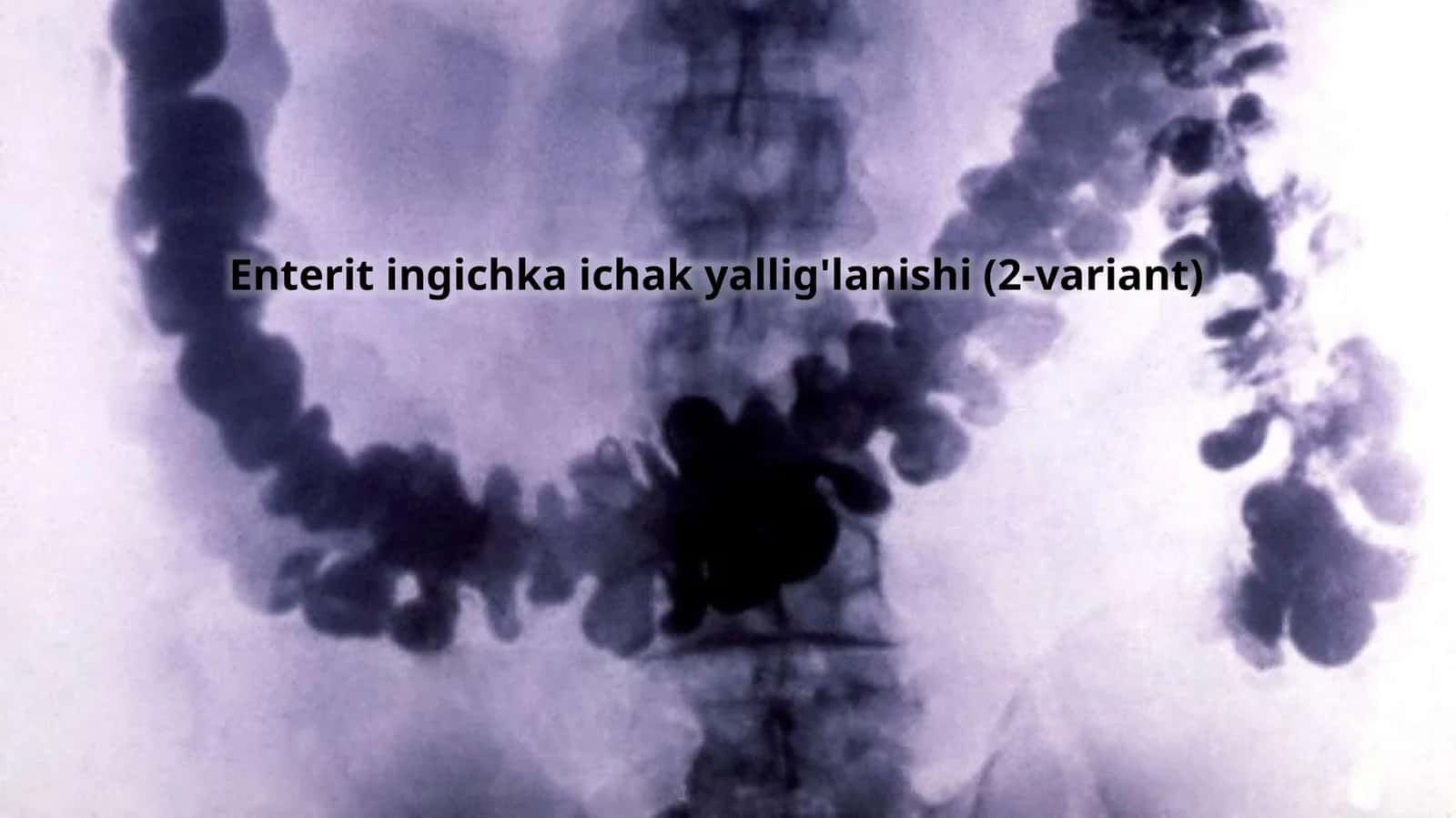 Enterit ingichka ichak yallig'lanishi (2-variant)