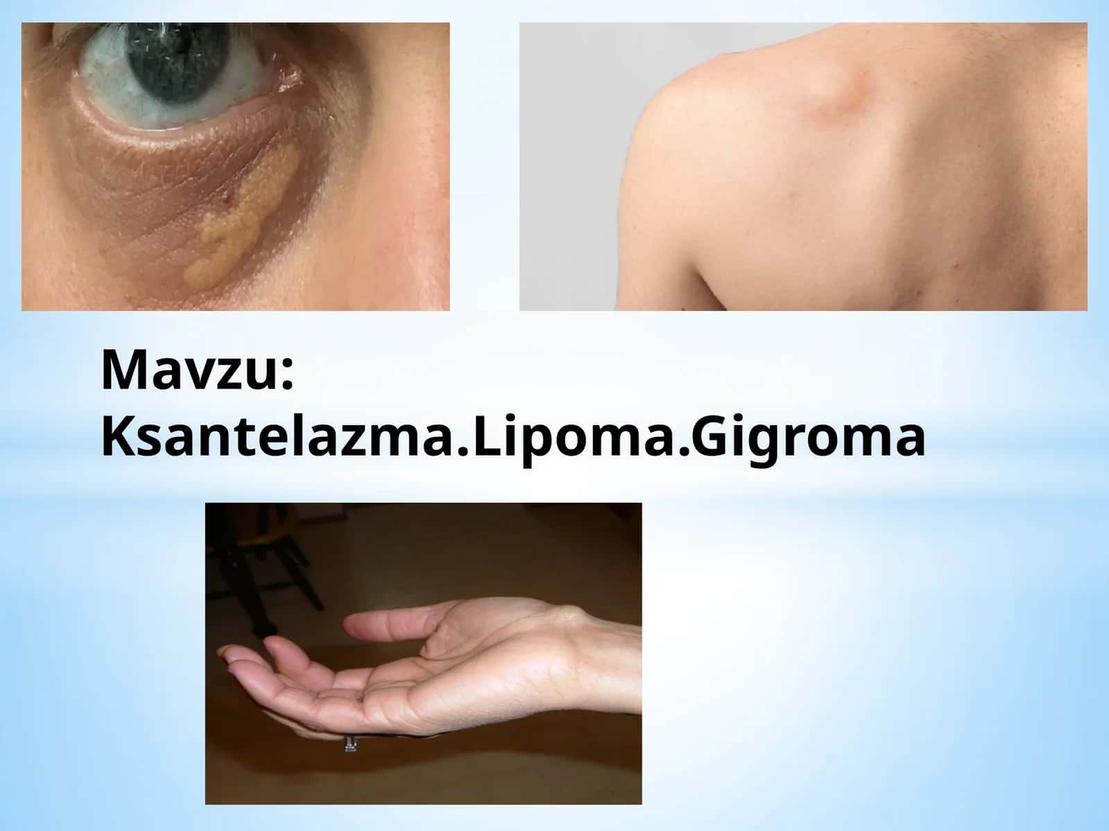 Ksantelazma.Lipoma.Gigroma