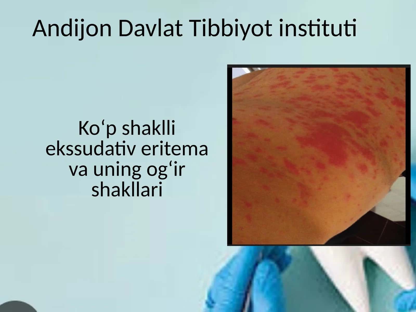 Ko‘p shaklli ekssudativ eritema va uning og‘ir shakllari