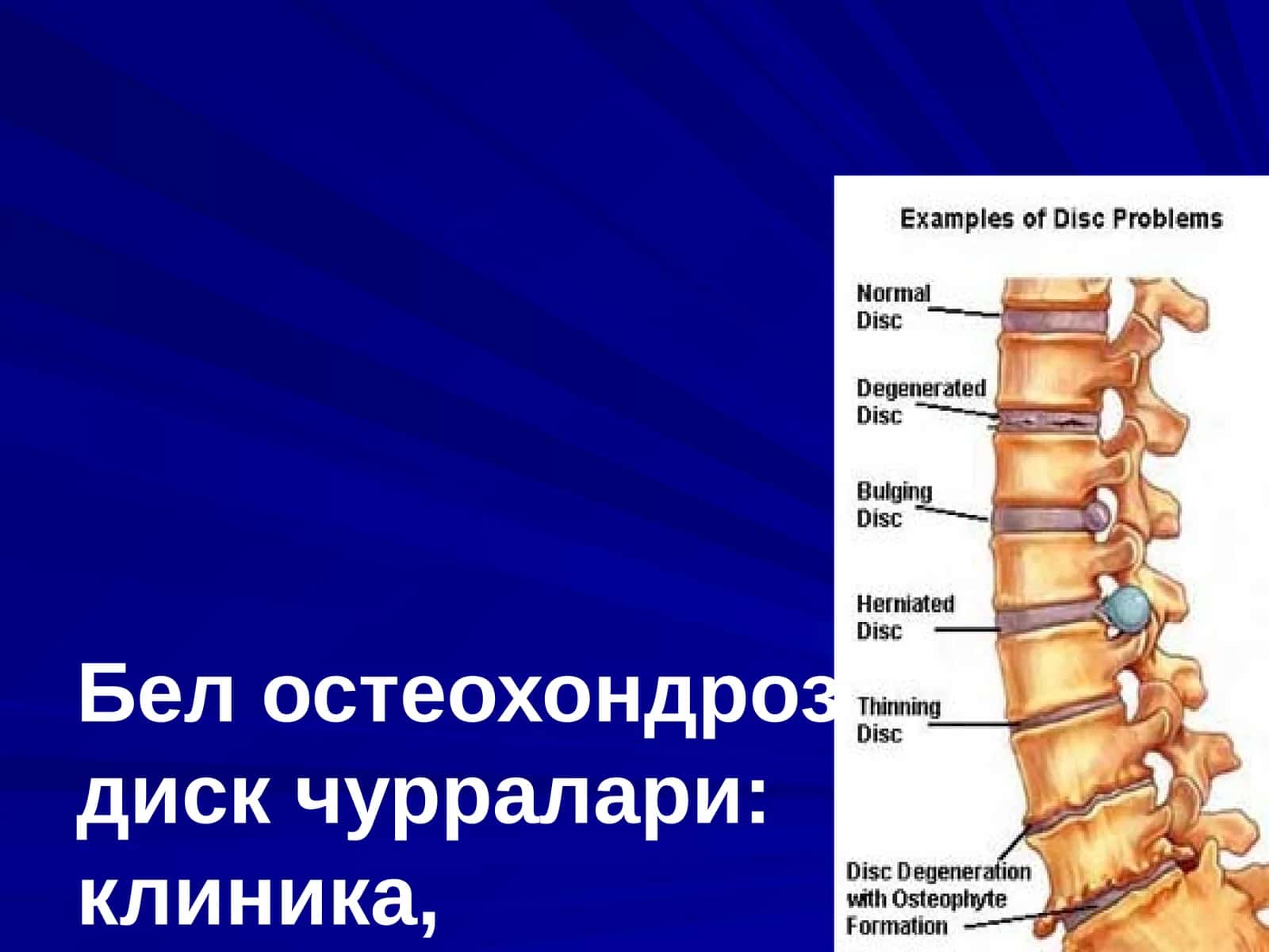 Бел остеохондрози, дискчурралари: клиника, диагностика, хирургик давоси