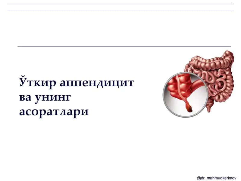 Ўткир аппендицит ва унинг асоратлари