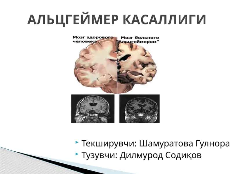 АЛЬЦГЕЙМЕР КАСАЛЛИГИ