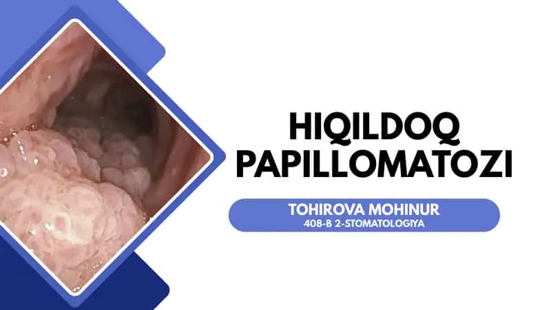 Hiqildoq papillomasi