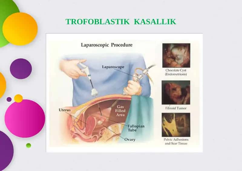 Trofoblastik kasallik