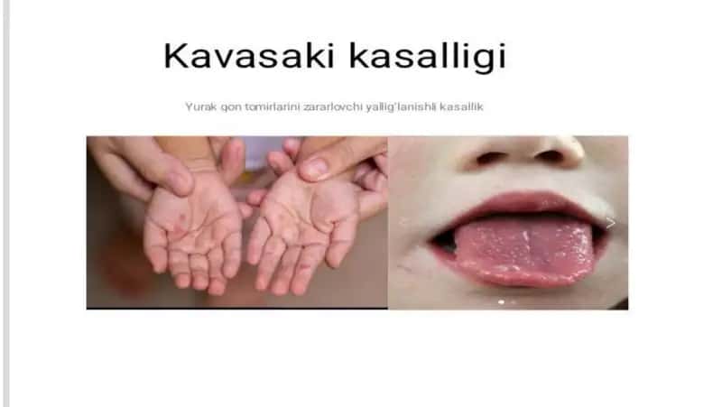 Kavasaki kasalligi