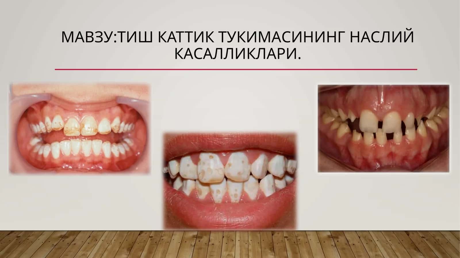 Тиш каттик тукимасининг наслий касалликлари