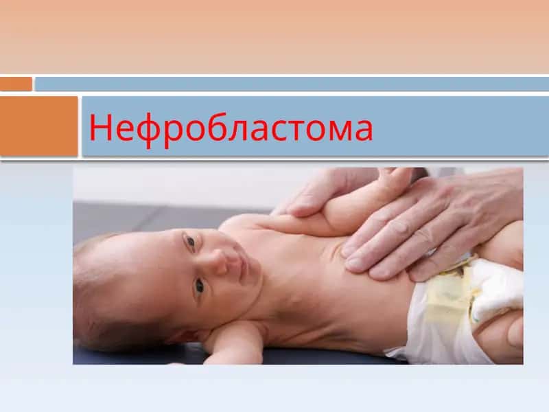 Нефробластома