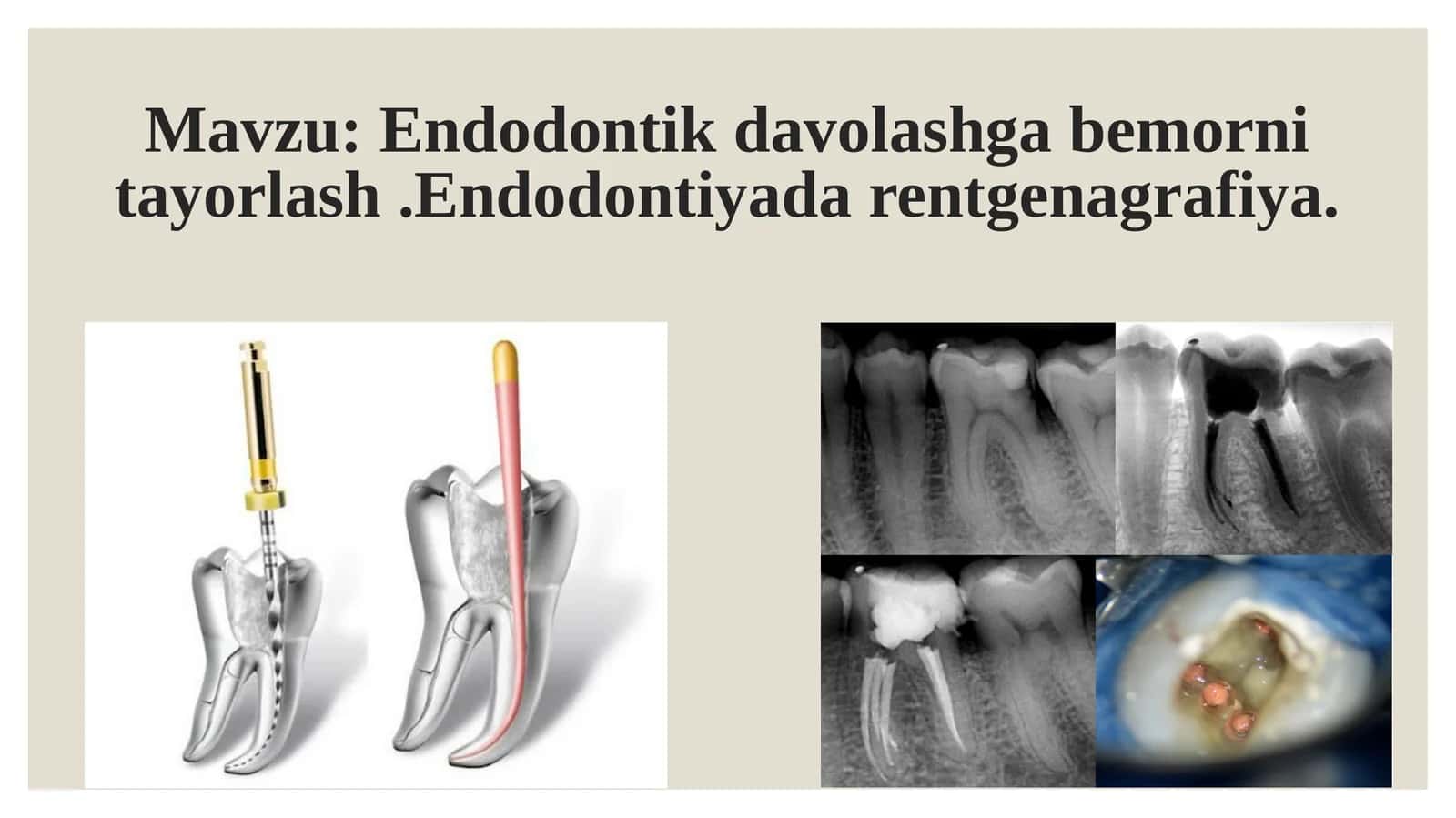 Endodontik davolash gabemorni tayyorlash