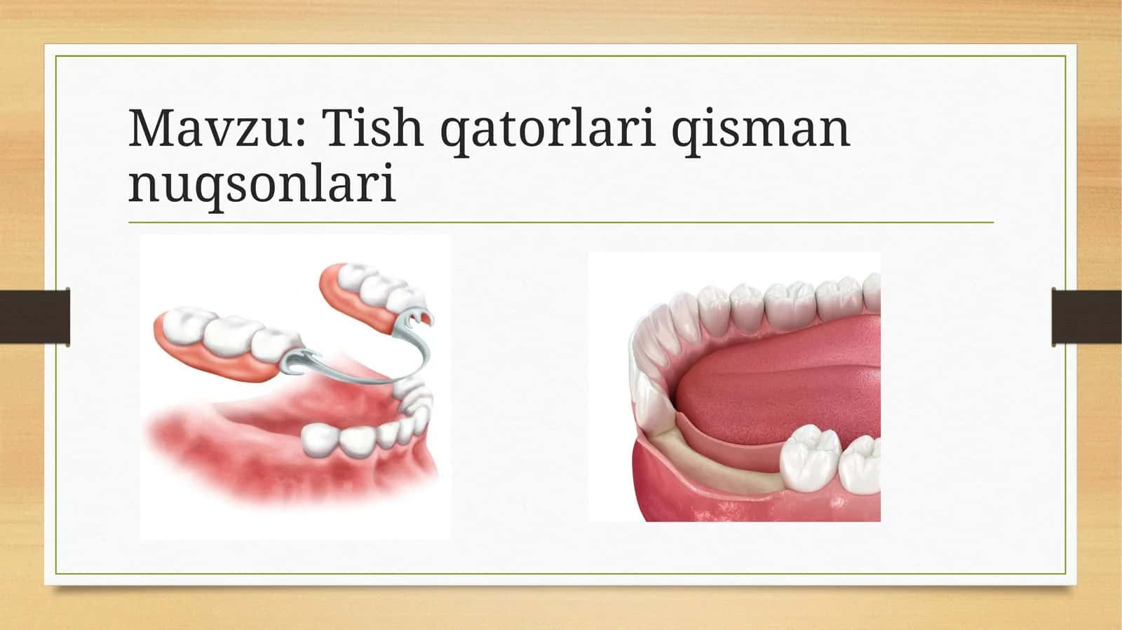 Tish qatorlari qisman nuqsonlari