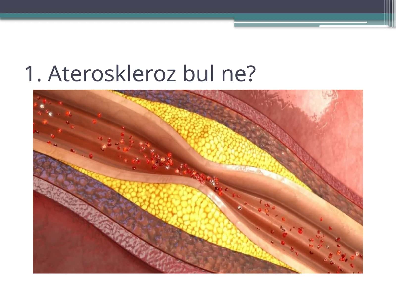 Ateroskleroz rawajlaniwi