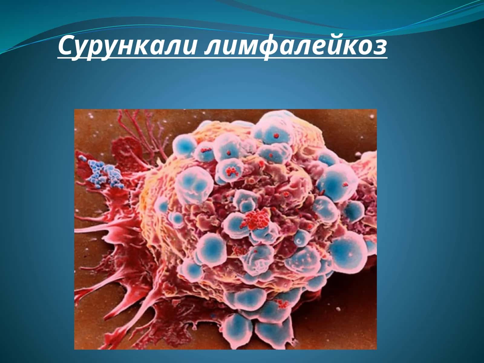 Сурункали лимфалейкоз