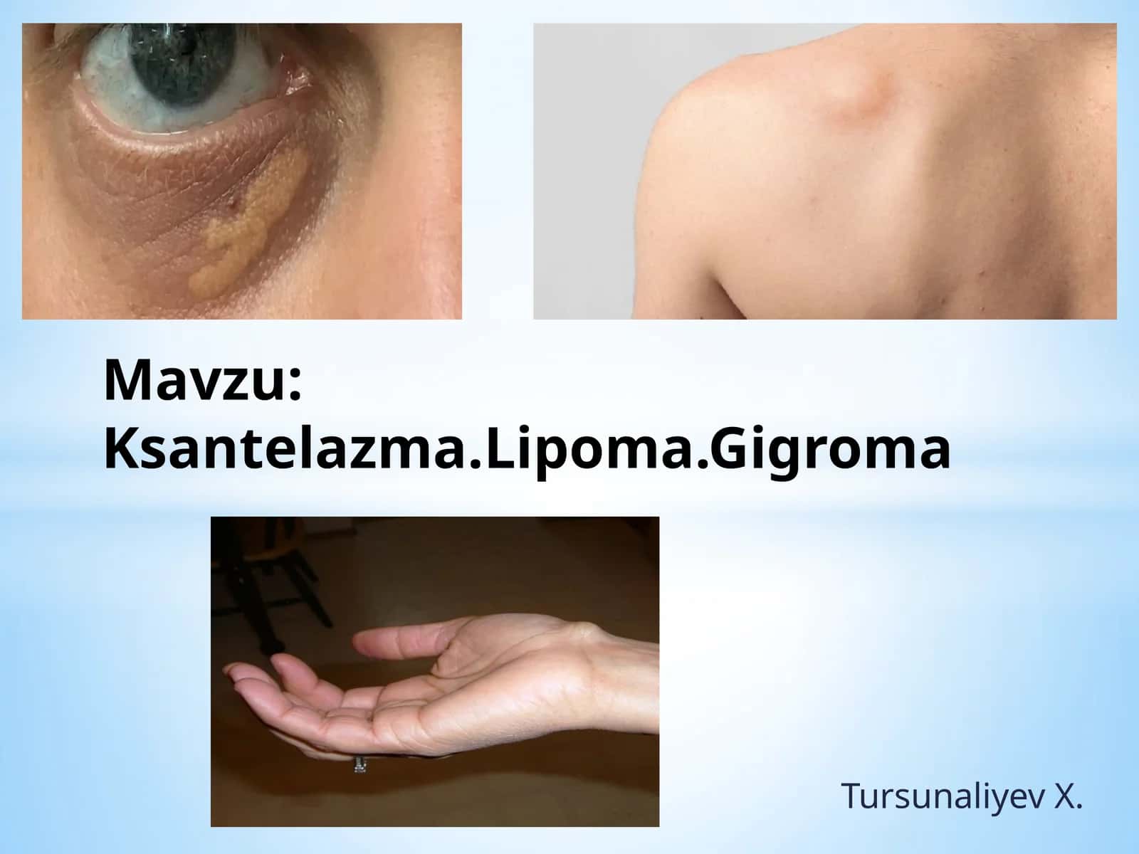 Ksantelazma.Lipoma.Gigroma