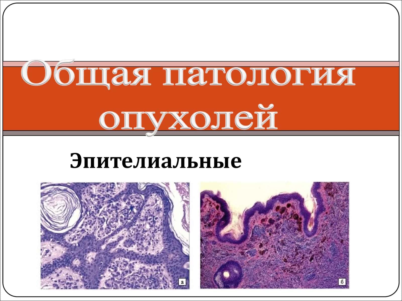 Эпителиальные опухоли