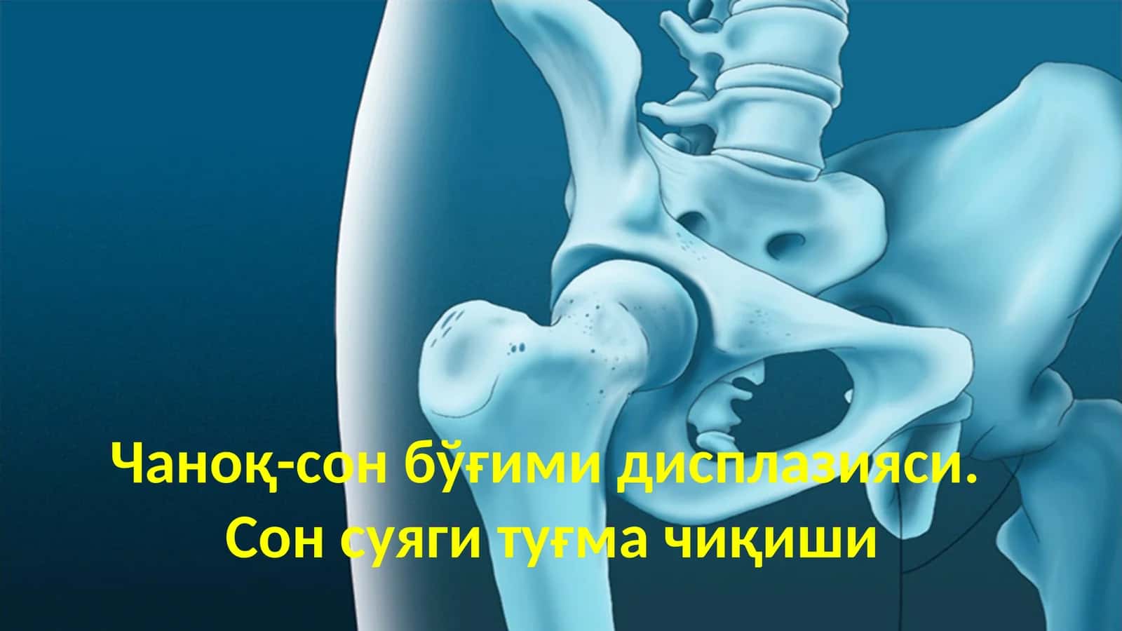 Чаноқ-сон бўғими дисплазияси