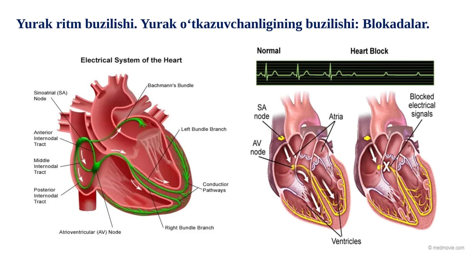 Yurak ritm buzilishi. Yurak o‘tkazuvchanligining buzilishi: Blokadalar.