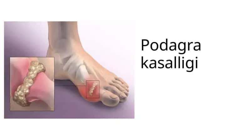 Podagra