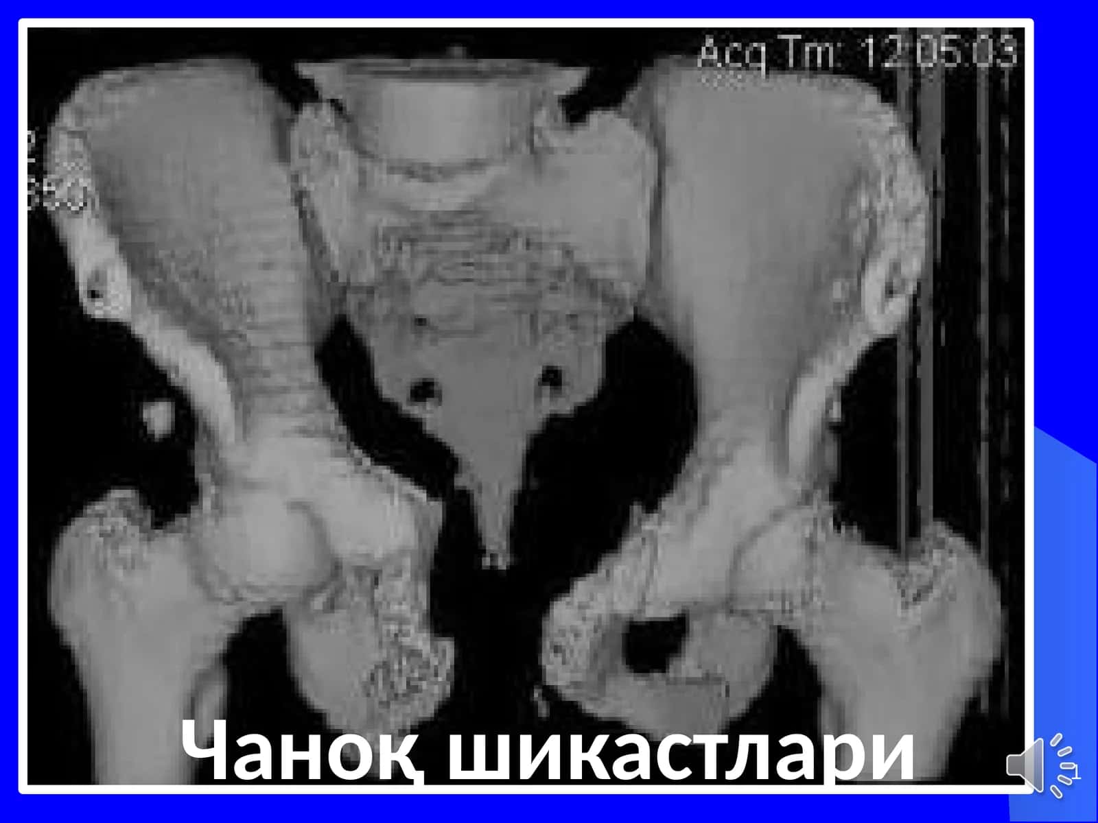 Чаноқ шикастлари